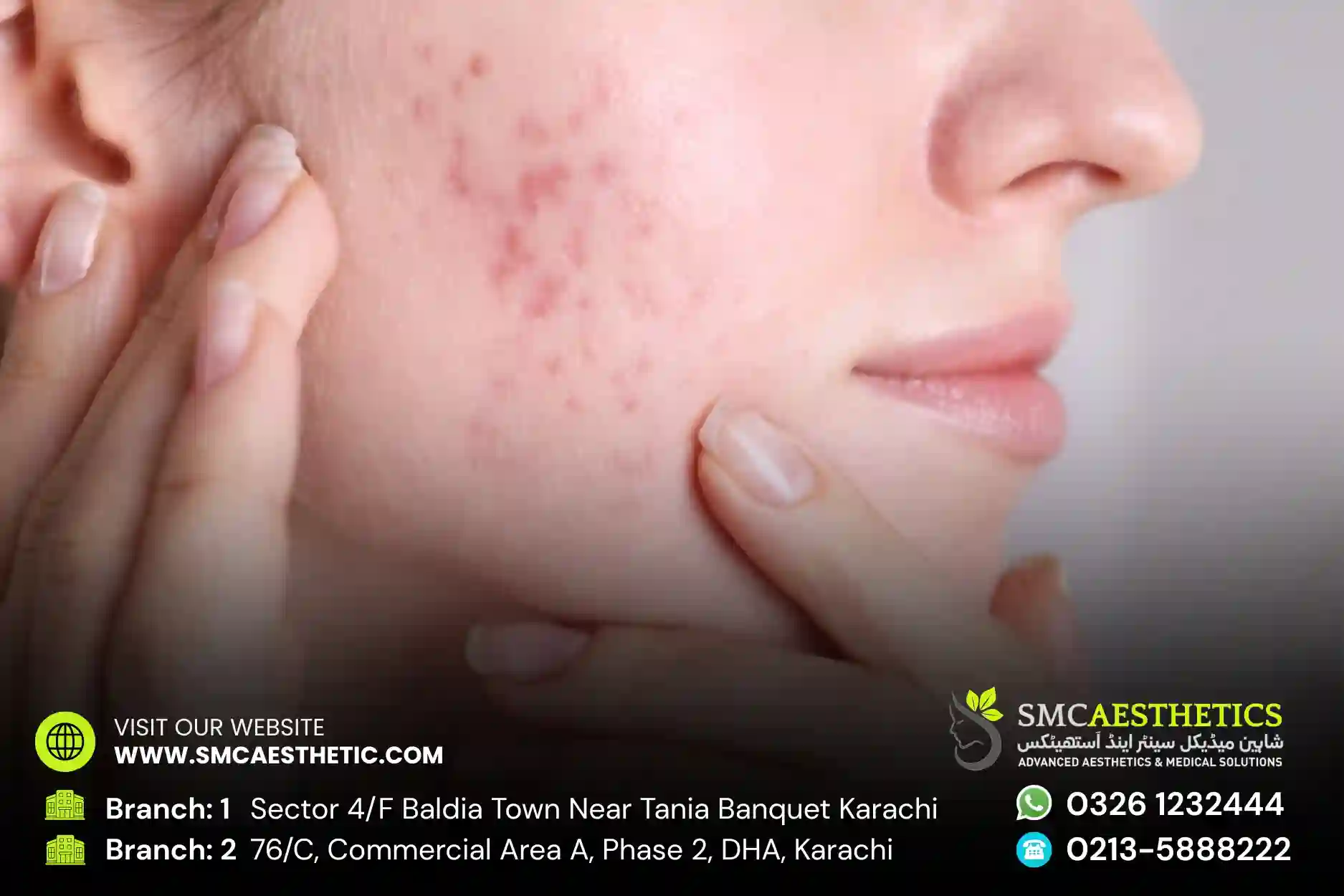 Acne Scars Treatment